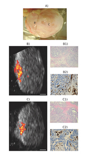 Imaging of a malignant postmenopausal ovary. (A) Coregistered ultrasound and photoacoustic images of two different locations are shown in B and C. (B1 and C1) H&E stains (A-40) of the corresponding areas showing extensive high-grade tumors. (B2 and C2) CD31 stains (A-100) of the corresponding areas showing extensive thin-walled microvessels. White bar, 5 mm. Reprinted with permission from Translational Oncology.