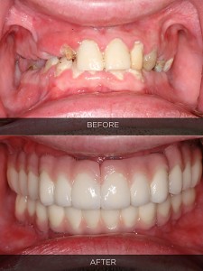 before_and_after_prosthodontics