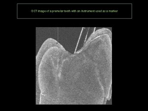 An image of a tooth generated by algorithms based on light photons reflected back from the target image area in the mouth, a method known as optical coherence tomography that spares the patient exposure to ionizing radiation.