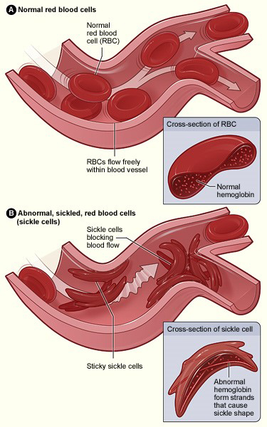 Illustration of normal and sickled red blood cells, from the National Institutes of Health website.