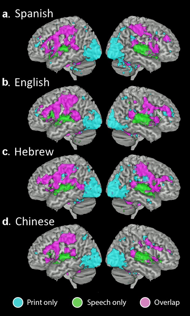 Intersect maps showing brain regions that are active for print only (cyan), speech only (green), or both print and speech (magenta). (Image courtesy of PNAS.)