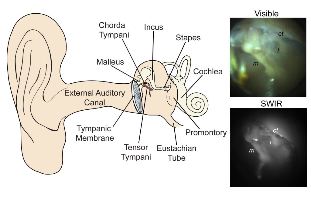 This diagram shows the structures of the middle ear, along with examples of the kinds of images provided by today’s conventional visible-light otoscopes (top) and by the newly developed short-wave infrared (SWIR) otoscope. The new otoscope can probe deeper to provide clearer indications of the presence of fluid which can indicate an infection. (Courtesy of the authors and PNAS)