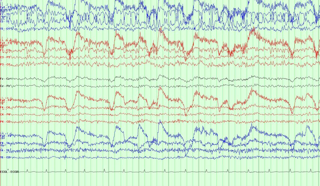 An EEG image showing seizures causing the brain to have spikes in its electrical signaling. The top blue and red EEG monitoring shows dramatic electrical signaling spike-and-wave discharges of the brain during an epilepsy patient’s seizure. At the same time the bottom red and blue EEG captures the relatively normal brain activity of the right side of the brain. (UConn Health Image)
