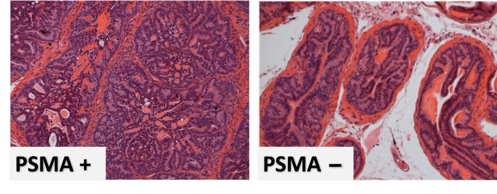 More PSMA, more problems. Prostate cells with more prostate-specific membrane antigen (PSMA, image on the left) have more cancer cells (purple), growing in a more disorganized way than the open ducts in a prostate whose cells have little PSMA (image on the right). (Caromile and Shapiro/UConn Health Image)