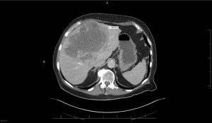 CT scan imaging revealing a large hepatocellular cancer involving the liver (Image courtesy of UConn Health/Dr. Jeffrey Wasser).