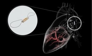 The miniature CardioMEMS device is minimally invasively implanted into a patient's pulmonary artery to immediately detect any early rise in pressure (Image by Abbott).