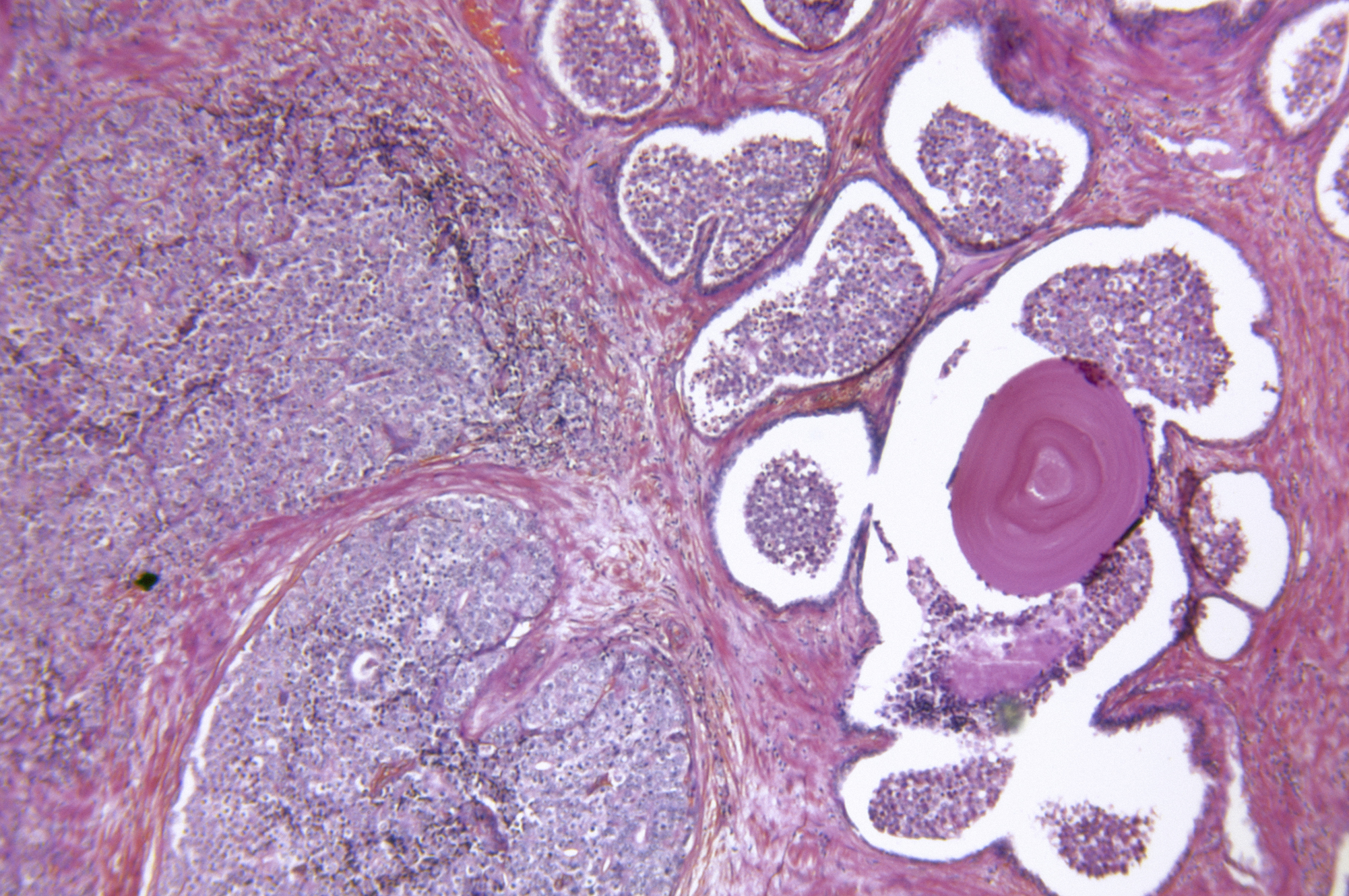Microscopic photo of a professionally prepared slide demonstrating the cellular structure of the prostate gland adenocarcinoma. (iStock Photo)