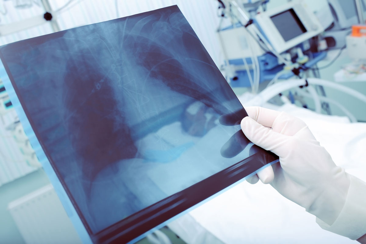 A doctor examines a patient’s chest x-ray, checking for possible pneumonia. (Shutterstock Photo)