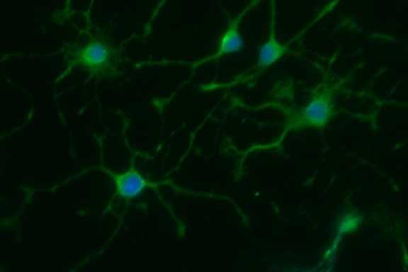 The young and the useless. Oligodendrocyte progenitor cells like these never mature properly in patients with primary progressive multiple sclerosis.
