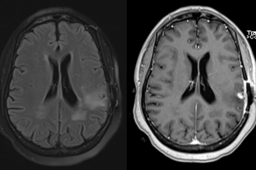 With UConn Health poised to open a new Epilepsy Monitoring Unit in April, the head of the neurology department discusses this common seizure condition. These MRI scans show a brain tumor and associated swelling that triggered a patient’s seizures. (UConn Health Image)