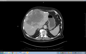 CT scan imaging revealing a large hepatocellular cancer involving the liver (Image courtesy of UConn Health/Dr. Jeffrey Wasser).