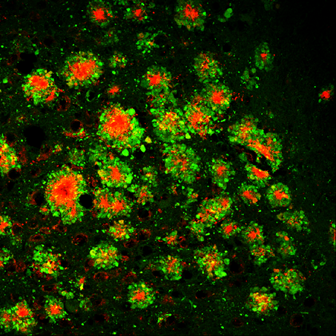 The research of Dr. Riqiang Yan, the newly named chair of UConn School of Medicine’s Department of Neuroscience, will continue to gain greater insight into the biological culprits behind Alzheimer’s disease. Yan’s research image shows the pathology of Alzheimer’s disease with buildup of both β-amyloid plaque (red) and also dystrophic neurites (green) caused by the RTN3 protein leading to memory loss and dementia in the elderly. (Image courtesy of Yan Lab).