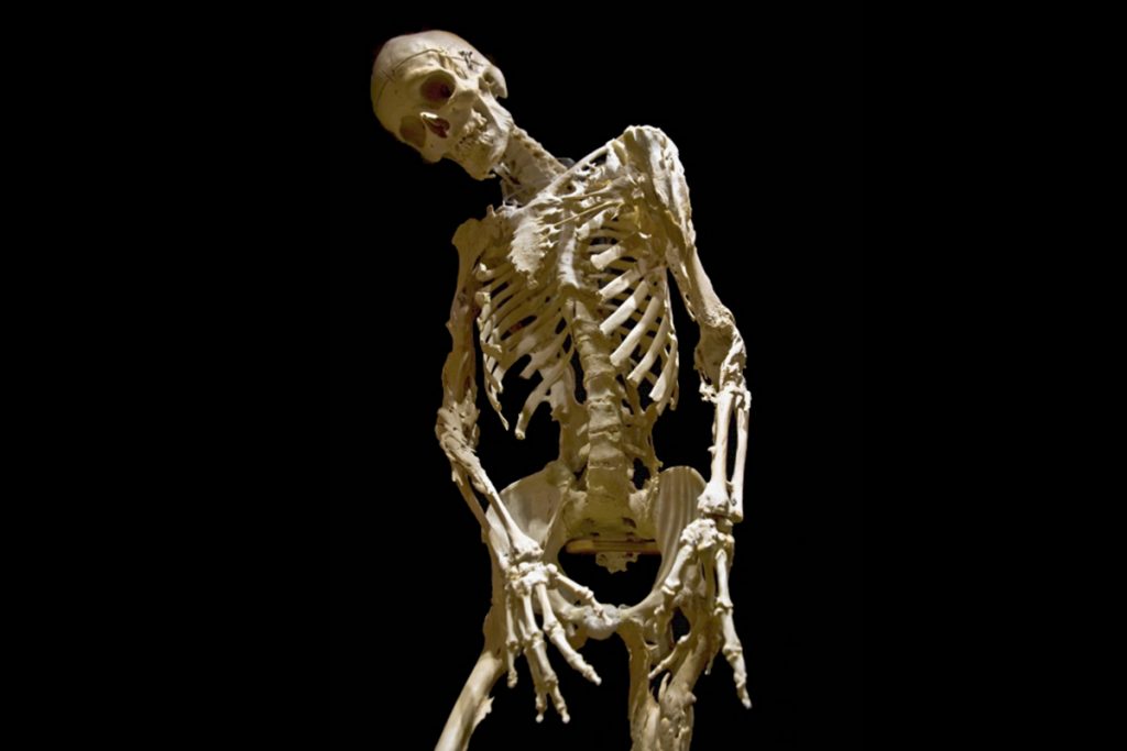 Skeleton of Harry Eastlack (1933-1973), who had a rare disorder called fibrodysplasia ossificans progressiva caused by a genetic mutation that transforms connective tissue, such as muscle, ligaments, and tendons, into bone, resulting in progressive fusion of all the joints in the skeletal system. (Memento Mütter Museum, under a Creative Commons License)