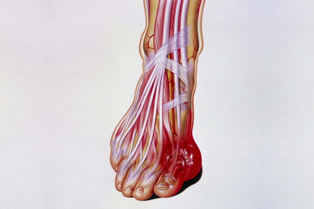 Illustration of the internal anatomy of a foot, showing a tophus (swelling) due to gout. The large toe is commonly affected. (John Bavosi/Science Photo Library via Getty Images)