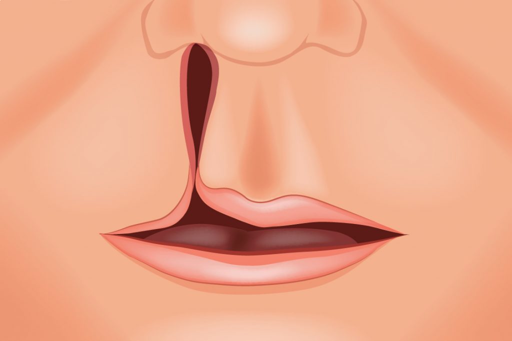 Clefts of the mouth and face, one of the most common birth defects, sometimes involve just a small indentation of a person’s lip, while in other cases the cleft splits deeply into the lip, upper palate, and even the nose. (Shutterstock)