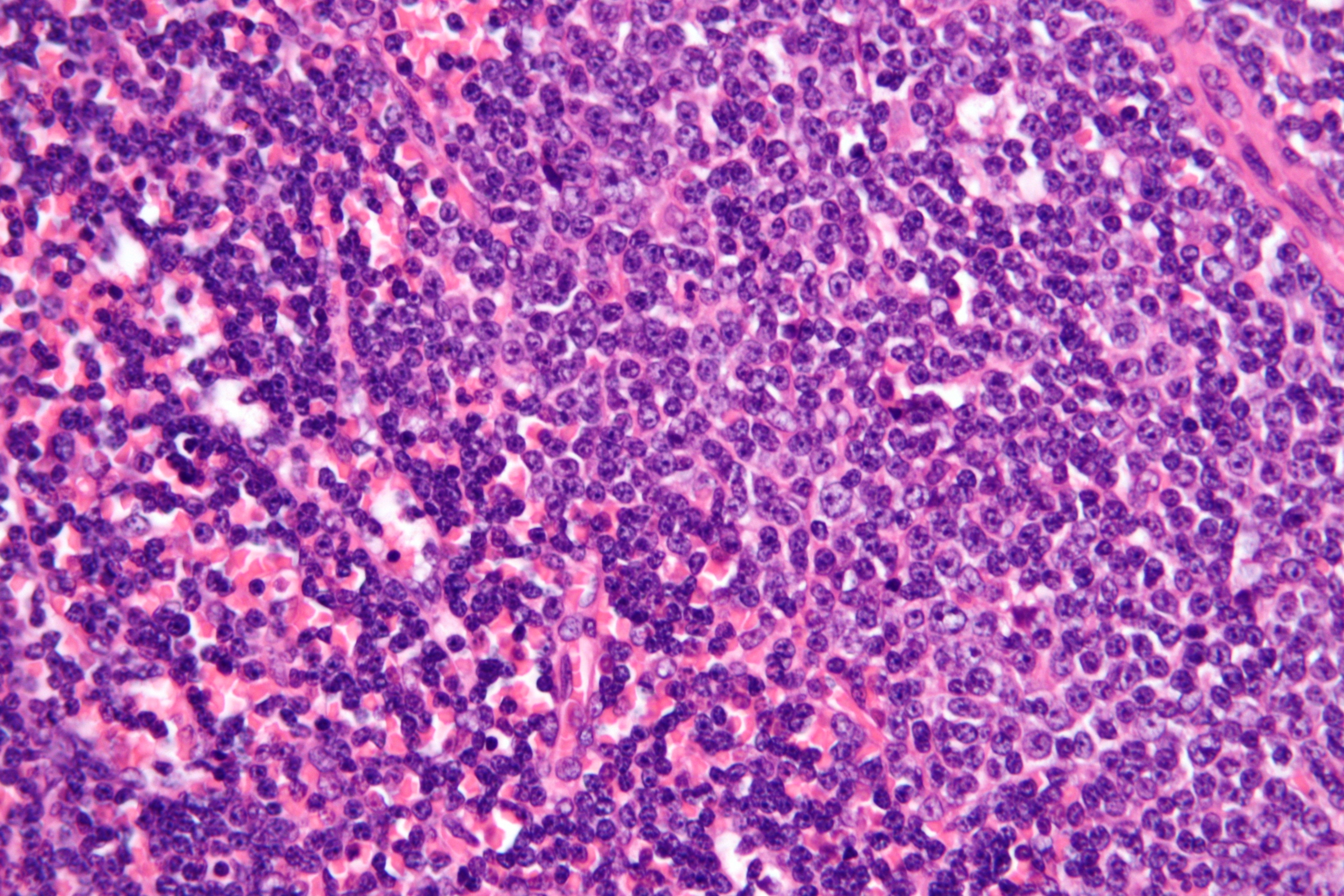 Very high magnification micrograph of B-cell chronic lymphocytic leukemia/small cell lymphoma. (Nephron/Wikimedia Commons)