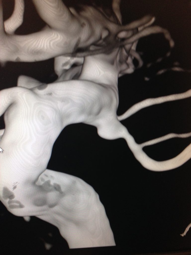 An angiogram image shows an anomaly in the right posterior communicating artery of the first patient treated in UConn Health's hybrid operating room. The high-resolution imaging allowed the care team to make a precise diagnosis.