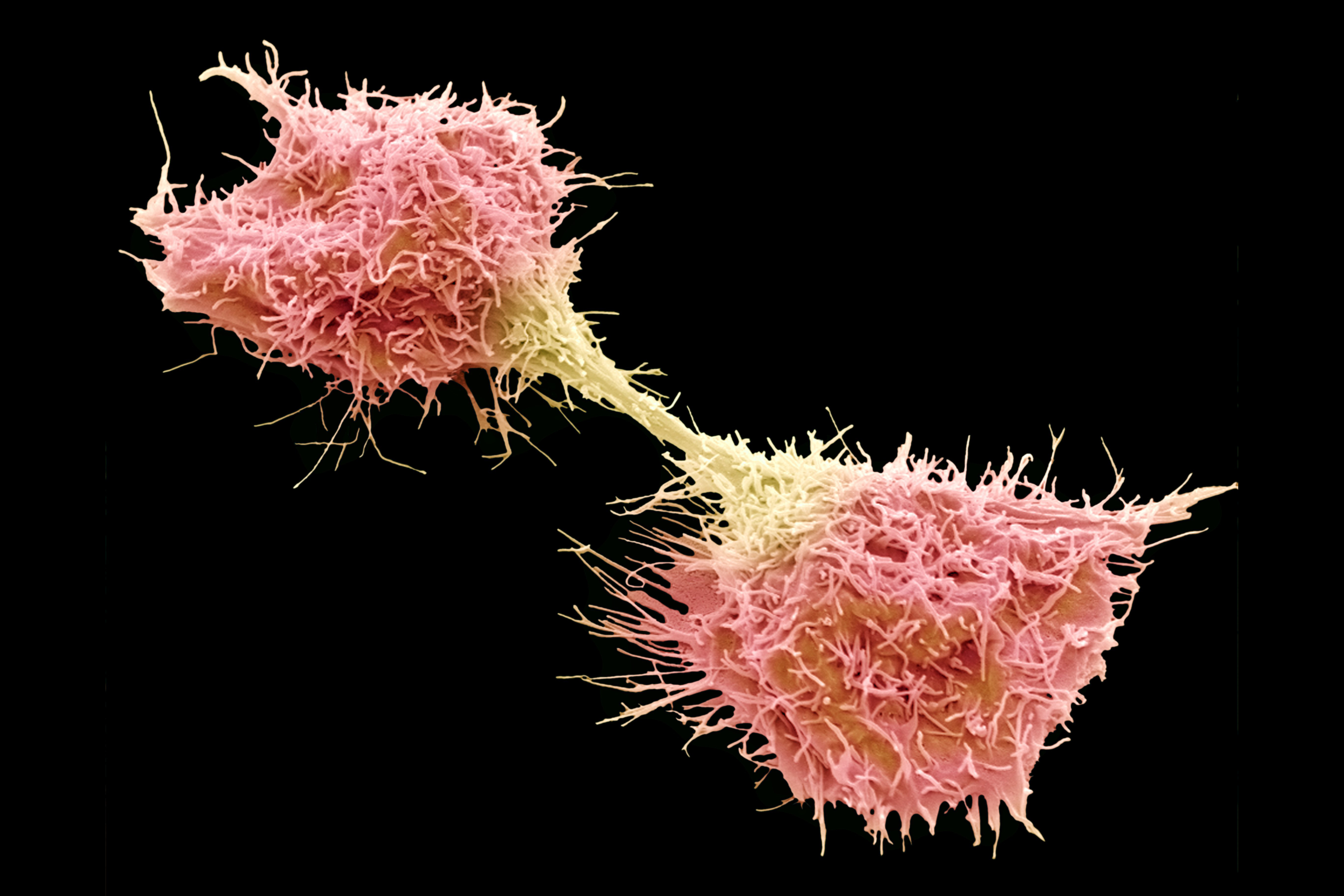 Dividing fibrosarcoma cells. Colored scanning electron micrograph of fibrosarcoma (fibroblastic sarcoma) cells in the late telophase stage of mitosis. The cells are covered in many filopodia. Fibrosarcoma is a malignant tumour derived from fibrous connective tissue of the bone and characterized by immature proliferating fibroblasts or undifferentiated anaplastic spindle cells. (Getty Images)