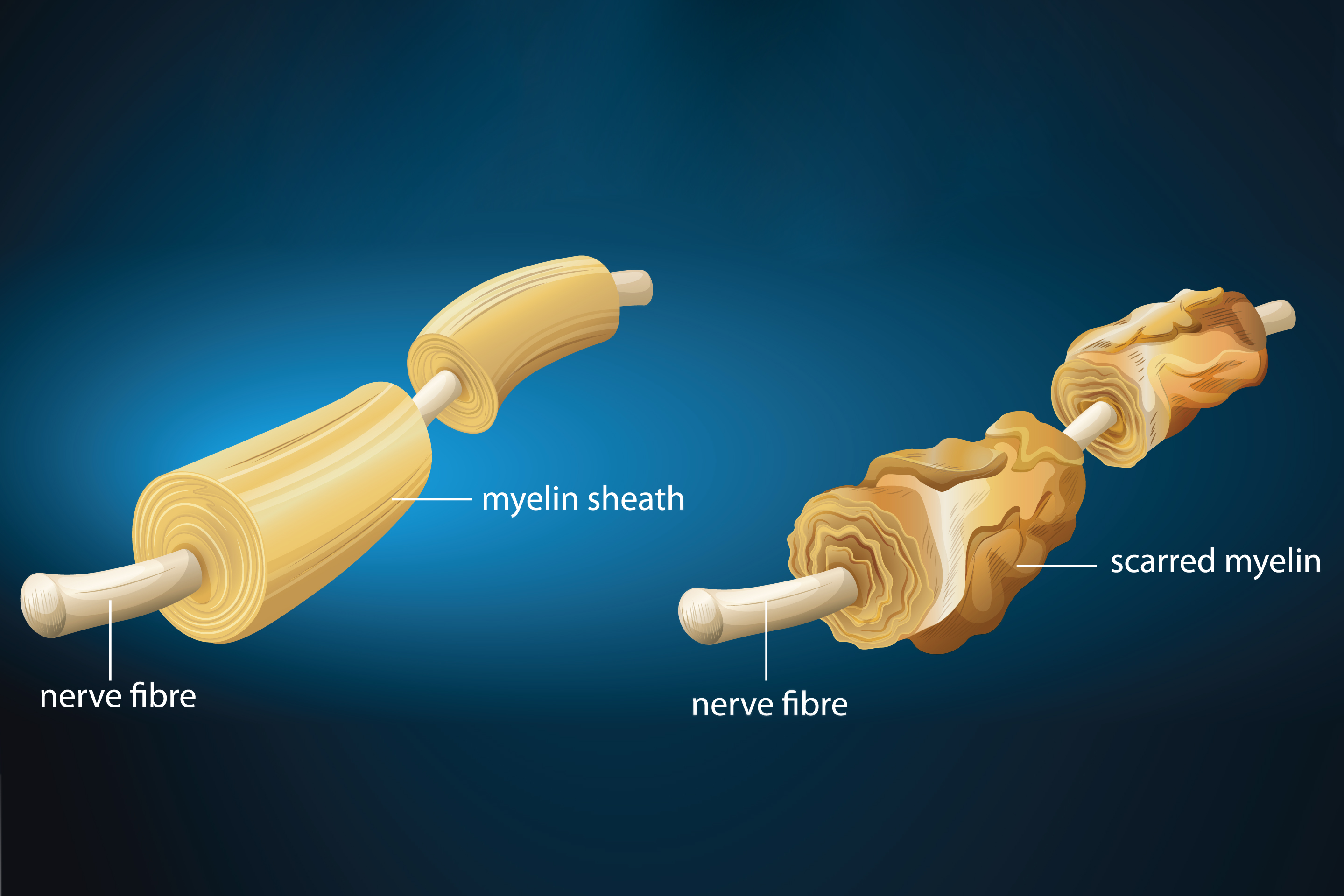 Multiple Sclerosis with demyelination. (Shutterstock Image)