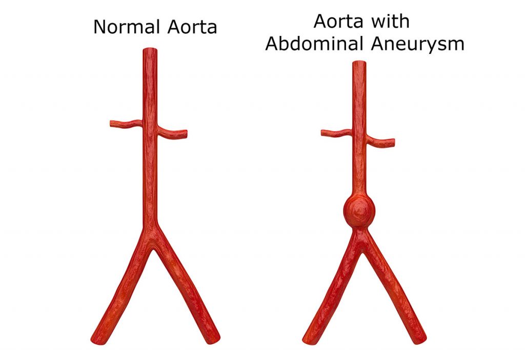 Diagram of abdominal aortic aneurysm