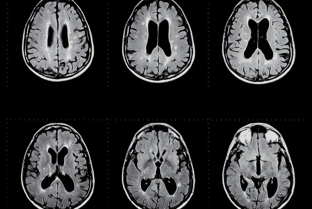 MRI exam of the human brain showing multiple sclerosis plaques. (Getty Images)