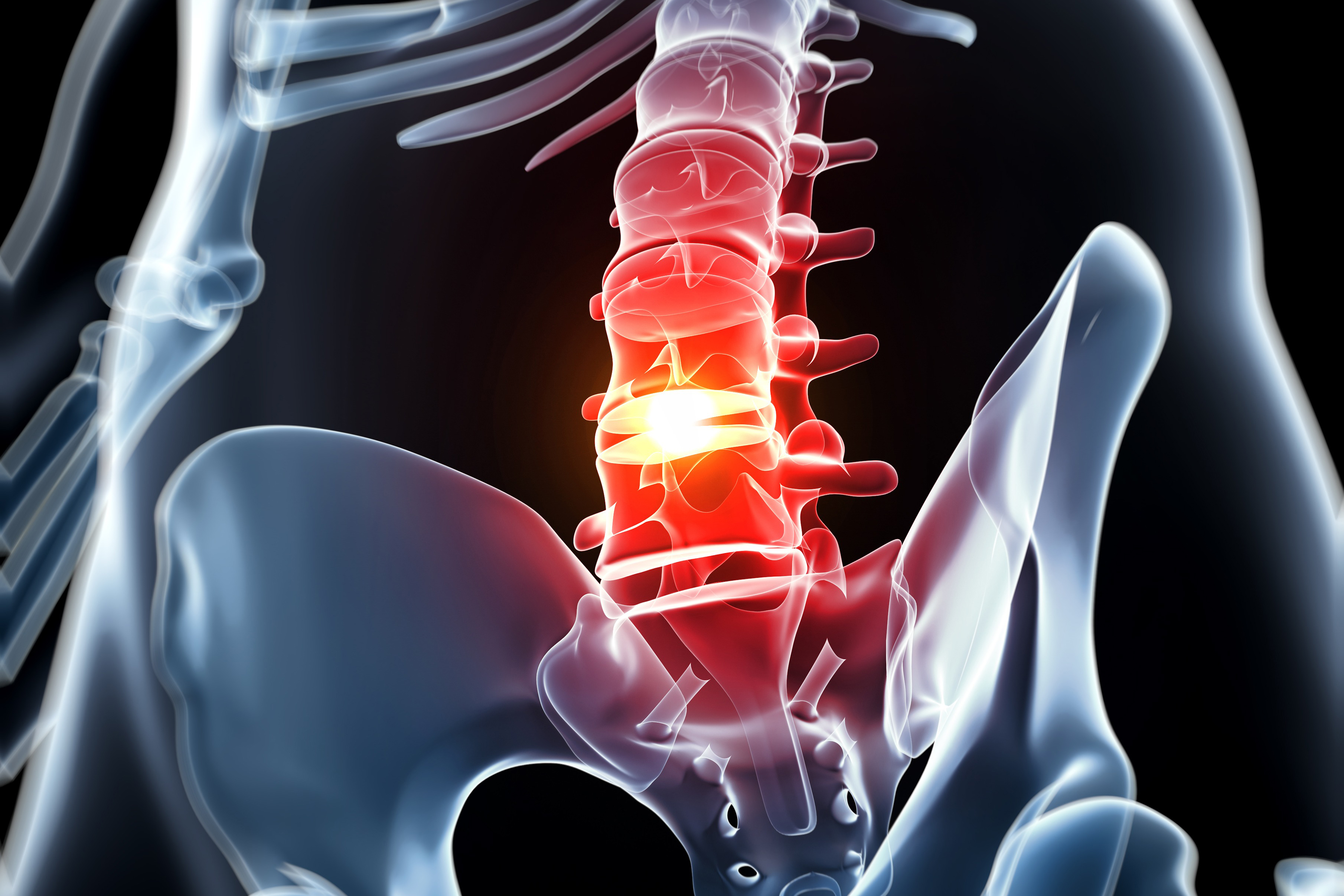 Human spine with slipped disc, computer artwork