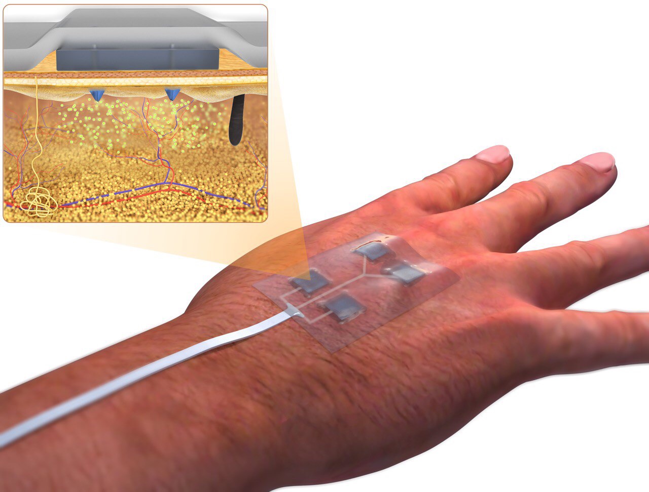 Illustration of the "smart bandage" developed by a UConn researcher.