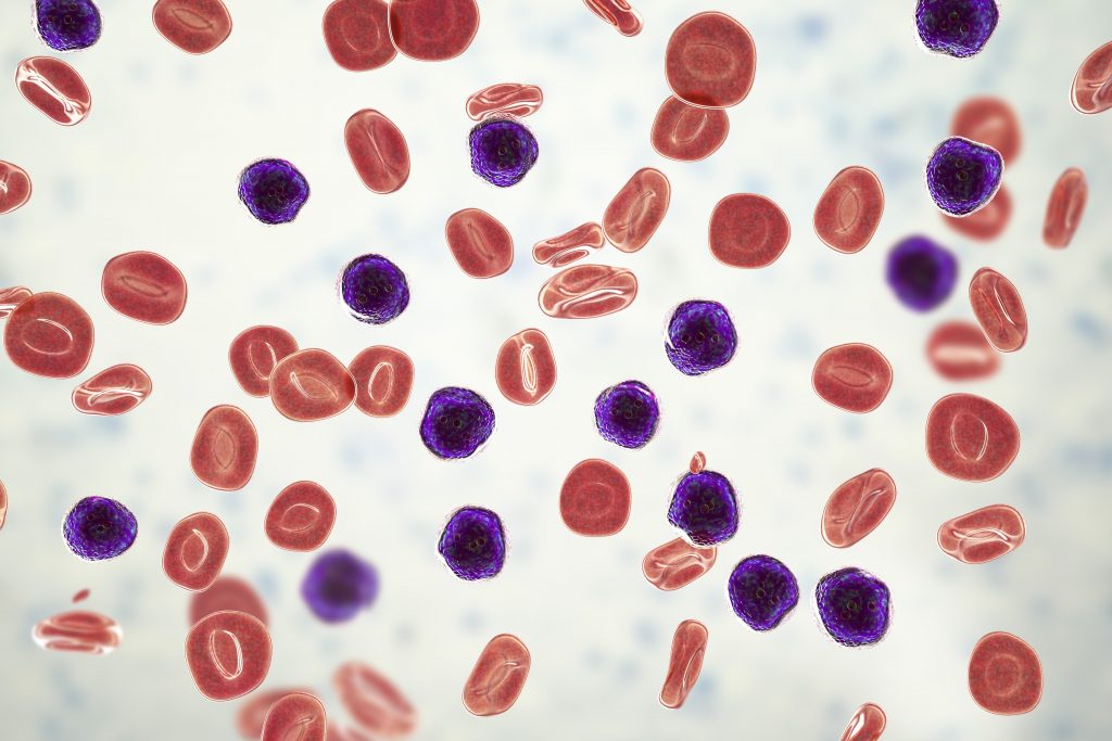 Acute lymphoblastic leukaemia. Computer illustration showing abundant lymphoblast cells in human blood.