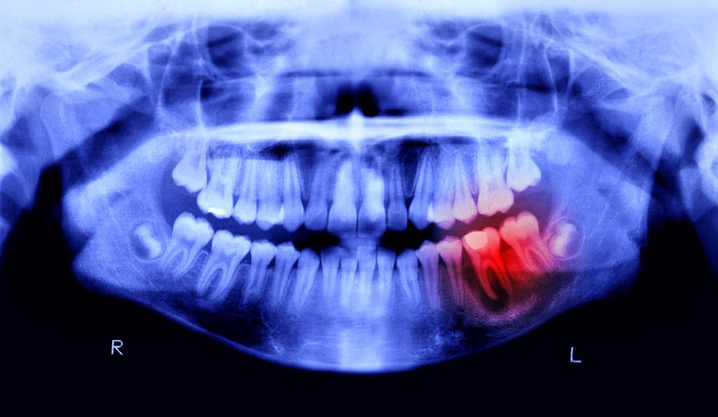 An x-ray image of a human mouth, with a tooth highlighted in red, indicating tooth pain.