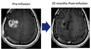 comparative brain scans showing diminished tumor size after 25 months of infusion