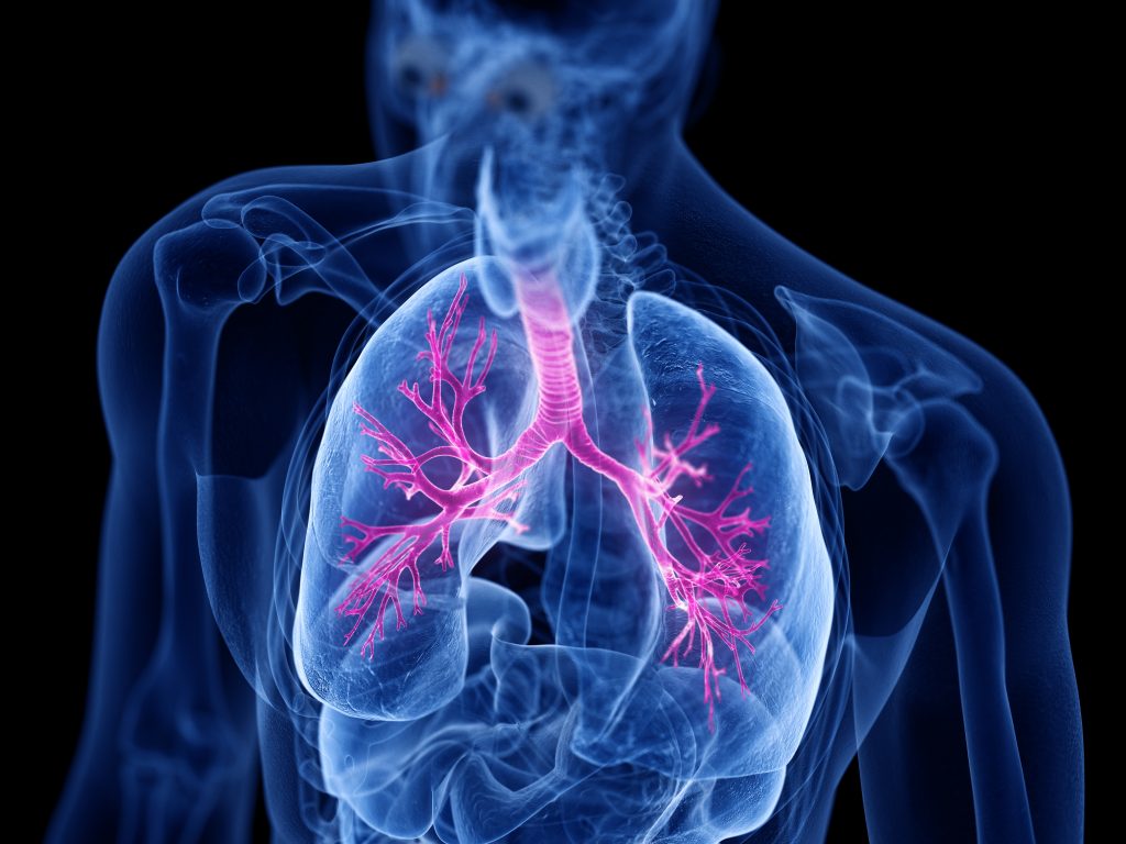 A 3-D rendering of the human bronchial system, affected by asthma.