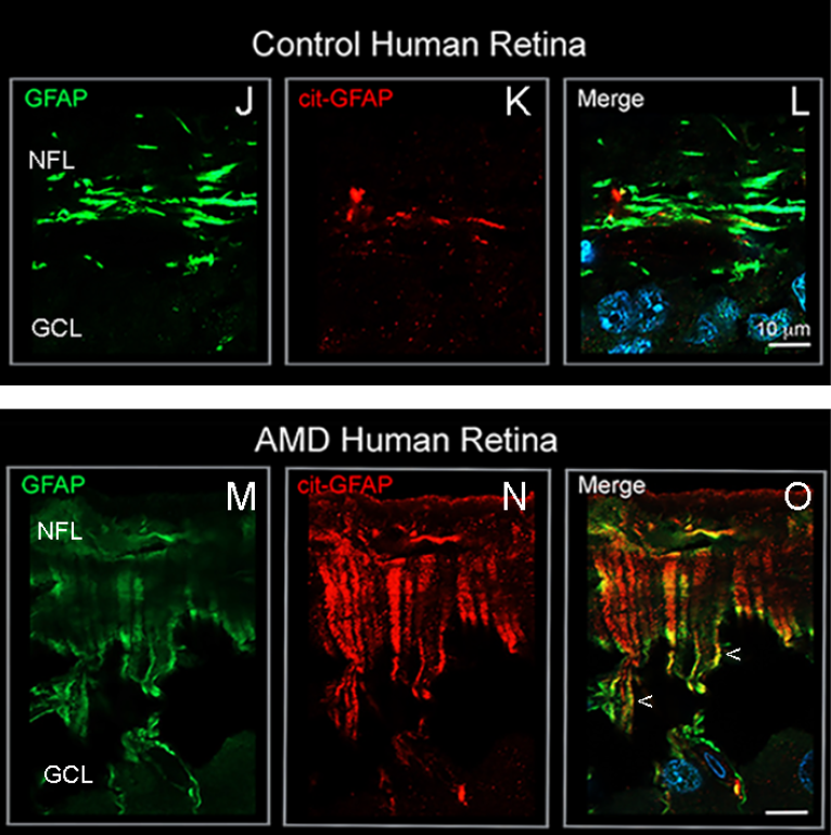 Healthy aged human retinas (J,K,L) have minimal stress proteins (green, J), little citrullination (red, K) and very little overlap (L), indicating low stress levels. In contrast, human retinas with advanced age-related macular degeneration produce abundant levels of stress proteins and increased citrullination (M, N) in Muller glia end feet, where extensive overlap between the two processes is seen (O). (Royce Mohan/UConn Health)