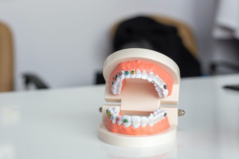 An orthodontic model of teeth with braces