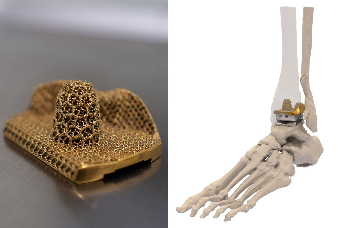 close-up of 3D-printed custom ankle replacement implant and image of anatomic rendering