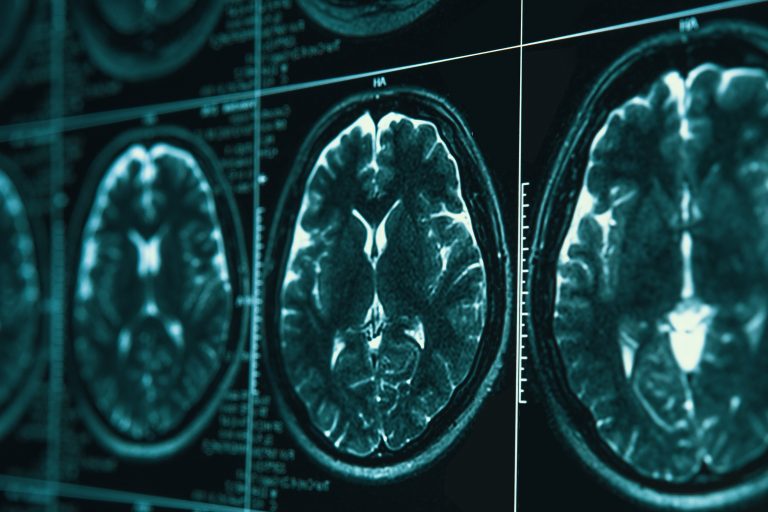 MRI or magnetic resonance image of head and brain scan.