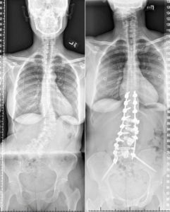 Xray images before and after spinal deformity correction