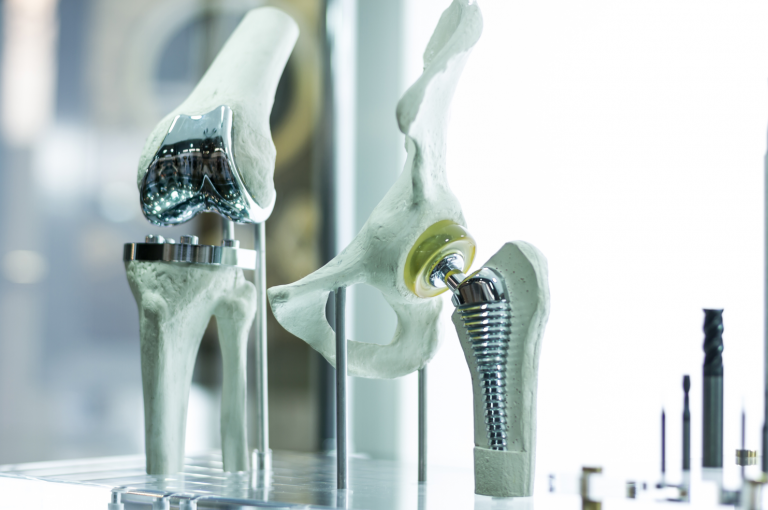 A model of metal joint replacements in a human knee.