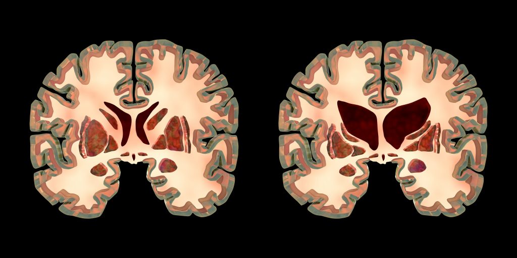 Huntington's Disease illustration of brain
