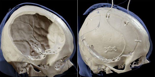 comparative images of a craniectomy and a cranioplasty