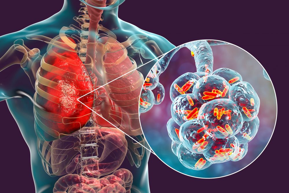 A medical illustration of bacterial pneumonia in the human lung