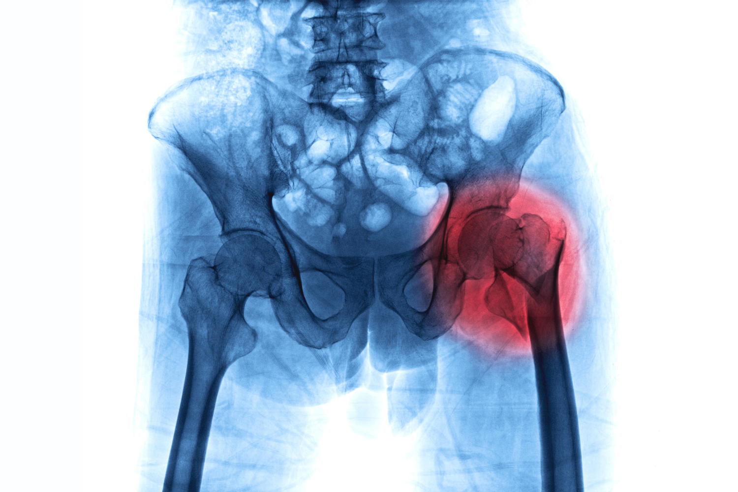 Hip fracture in older adult (AdobeStock Image).