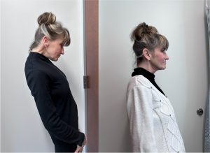 profile photos of Julie Dorio before and after surgery