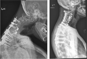 Xrays of Julies neck and spine