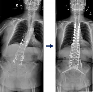 Xrays of Tina Kasniak's spine before and after surgery