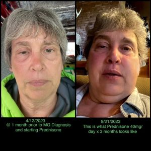 Nancy Nye on left side with drooping eye lid, Nancy Nye bloated on prednisone on the right side
