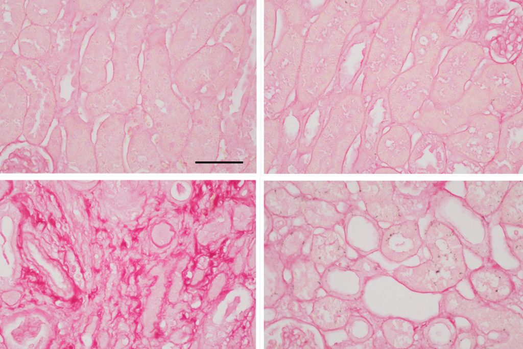 A four image panel showing close-up imagery scar tissue in kindeys