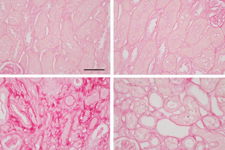 A four image panel showing close-up imagery scar tissue in kindeys