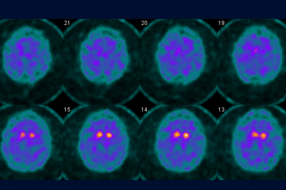 A Pill Explores New Frontier in Early Parkinson’s Disease Treatment ...