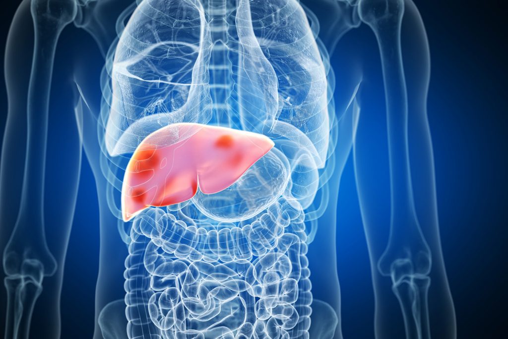 3d rendered medically accurate illustration of liver tumors