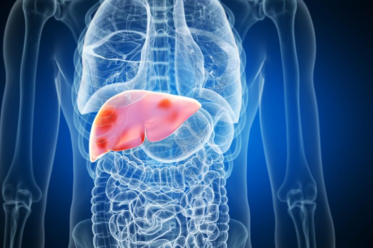 3d rendered medically accurate illustration of liver tumors